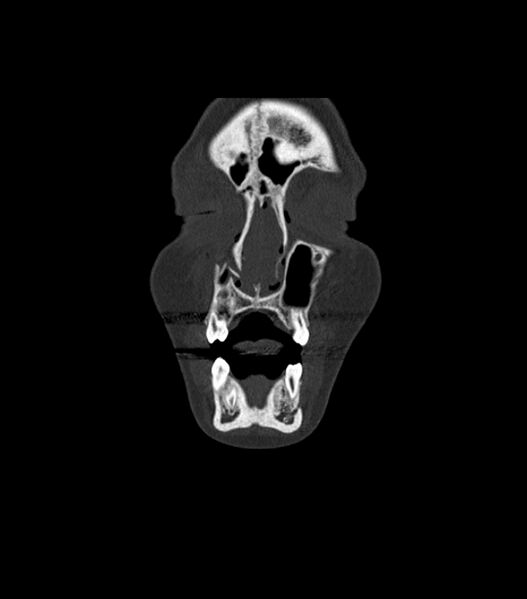 File:Nasoorbitoethmoid fracture (Radiopaedia 90044-107205 Coronal bone window 31).jpg