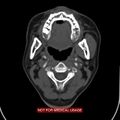 Nasopharyngeal carcinoma recurrence - skull base destruction (Radiopaedia 29107-29491 A 16).jpg