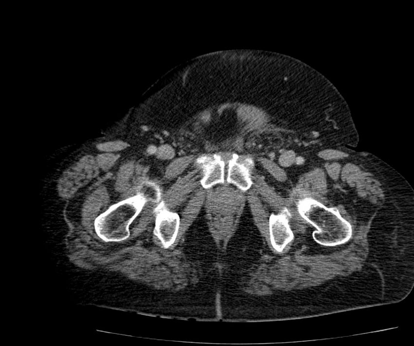 Nephroptosis with inguinal hernia containing perirenal fat (Radiopaedia 56632-63391 C 331).jpg