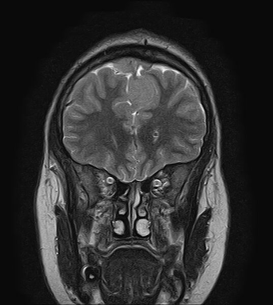 File:Neurofibromatosis type 2 (Radiopaedia 66211-75401 Coronal T2 6).jpg