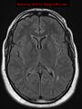 Neuroglial cyst (Radiopaedia 10713-11184 Axial FLAIR 11).jpg