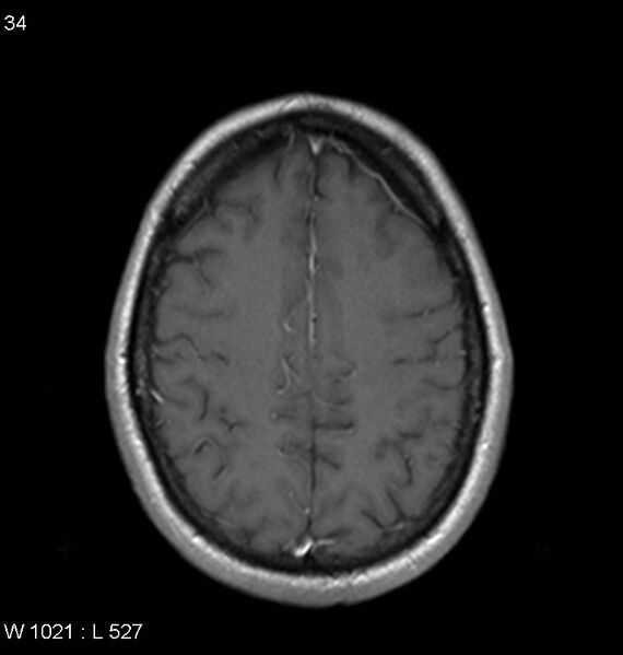 File:Neurosarcoidosis (Radiopaedia 10930-11351 Axial T1 C+ 15).jpg