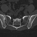 Normal CT lumbar spine (Radiopaedia 53981-60118 Axial bone window 73).jpg
