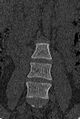 Normal CT lumbar spine (Radiopaedia 53981-60118 Coronal bone window 12).jpg