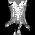 Normal CT of the neck (Radiopaedia 14575-14500 Coronal C+ 31).jpg