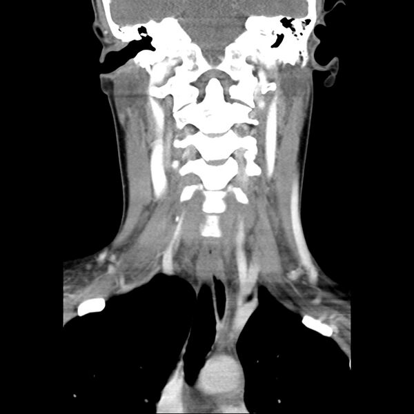 File:Normal CT of the neck (Radiopaedia 14575-14500 Coronal C+ 31).jpg