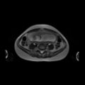 Normal MRI abdomen in pregnancy (Radiopaedia 88001-104541 Axial T2 45).jpg