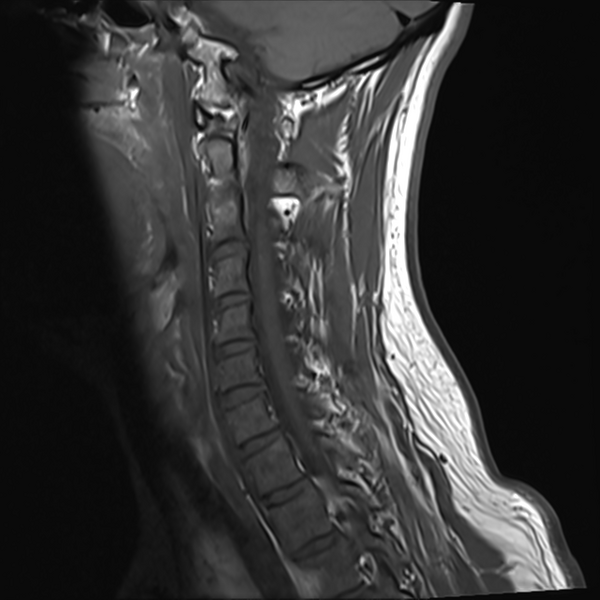 File:Normal MRI cervical spine (infection protocol) (Radiopaedia 53916-60039 Sagittal T1 5).png
