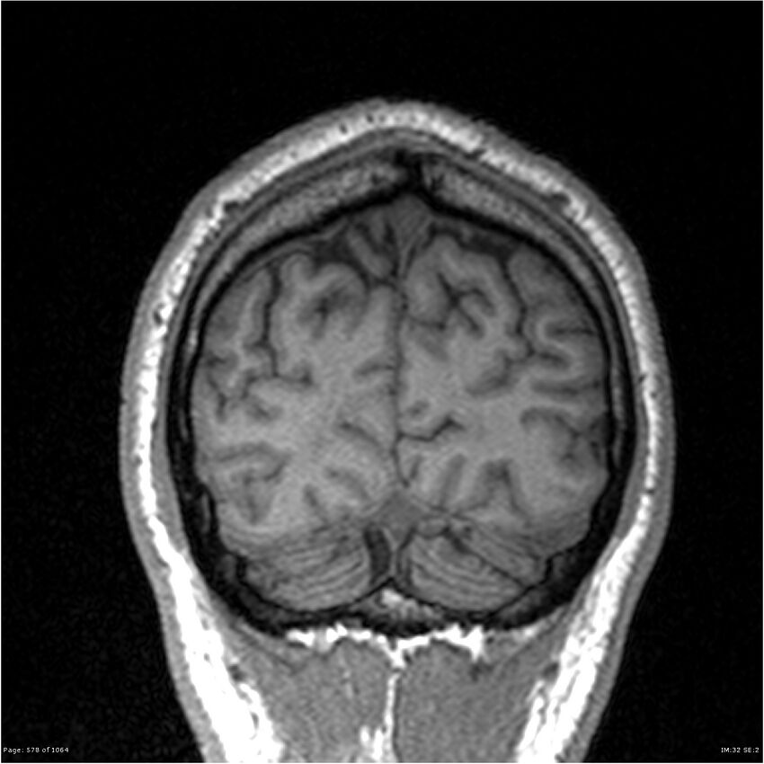 Normal brain MRI (non-focal epilepsy protocol) (Radiopaedia 38571-40700 Coronal T1 15).jpg