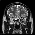 Normal coronal brain (Radiopaedia 6676-7910 Coronal T2 9).jpg