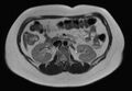 Normal liver MRI with Gadolinium (Radiopaedia 58913-66163 Axial T2 12).jpg