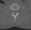 Normal lumbar spine CT (Radiopaedia 46533-50986 Axial bone window 40).png