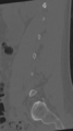 Normal lumbar spine CT (Radiopaedia 46533-50986 Sagittal bone window 72).png