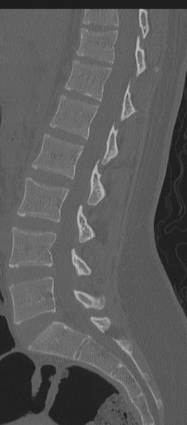 File:Normal lumbosacral CT (Radiopaedia 37923-39867 Sagittal bone window 52).png