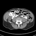 Normal multiphase CT liver (Radiopaedia 38026-39996 Axial non-contrast 51).jpg