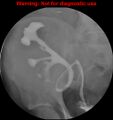 Normal retrograde pyelography of a native and transplant kidney (Radiopaedia 40480-43054 Transplant kidney 14).jpg