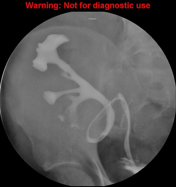 File:Normal retrograde pyelography of a native and transplant kidney (Radiopaedia 40480-43054 Transplant kidney 14).jpg