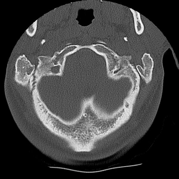 File:Normal trauma spine imaging (Radiopaedia 31753-32686 Axial bone window 2).jpg