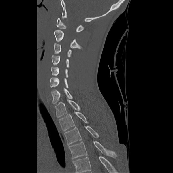File:Normal trauma spine imaging (age 16) (Radiopaedia 45335-49358 Sagittal bone window 15).jpg