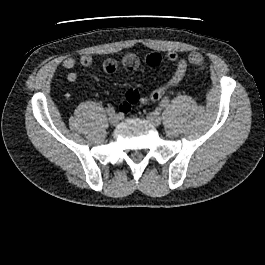 Obstructing ureteric calculus and ureteric anatomy (Radiopaedia 62730-71042 Axial non-contrast 112).jpg