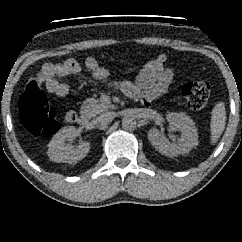 Obstructing ureteric calculus and ureteric anatomy (Radiopaedia 62730-71042 Axial non-contrast 32).jpg