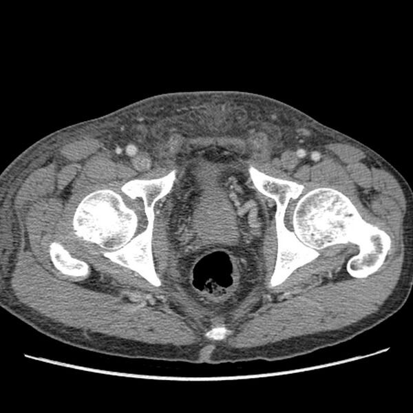 File:Obstructive bladder transitional cell carcinoma (Radiopaedia 9825-10410 A 35).jpg