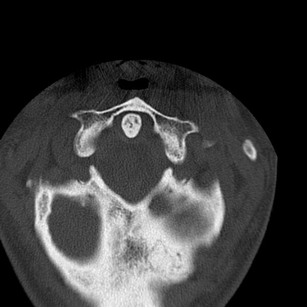 File:Occipital condyle fracture (Radiopaedia 31755-32691 Axial bone window 11).jpg