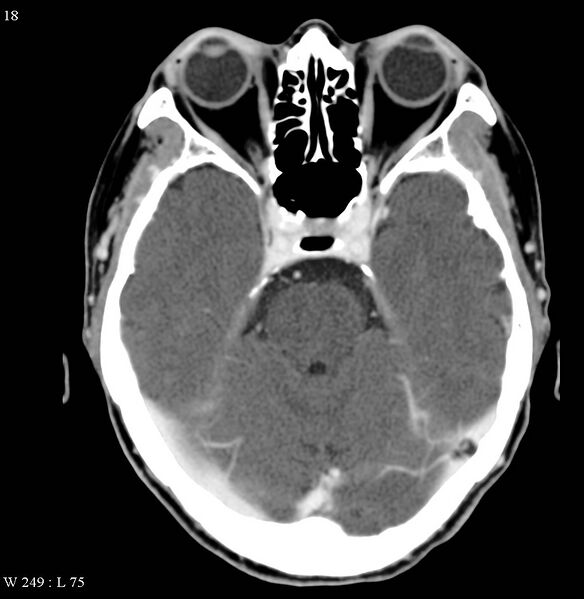 File:Occipital condyle metastasis - into mastoid (Radiopaedia 5424-7177 B 14).jpg