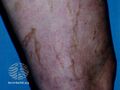 Post-sclerotherapy staining (DermNet NZ colour-haemo1).jpg