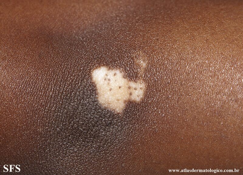 File:Vitiligo (Dermatology Atlas 70).jpg