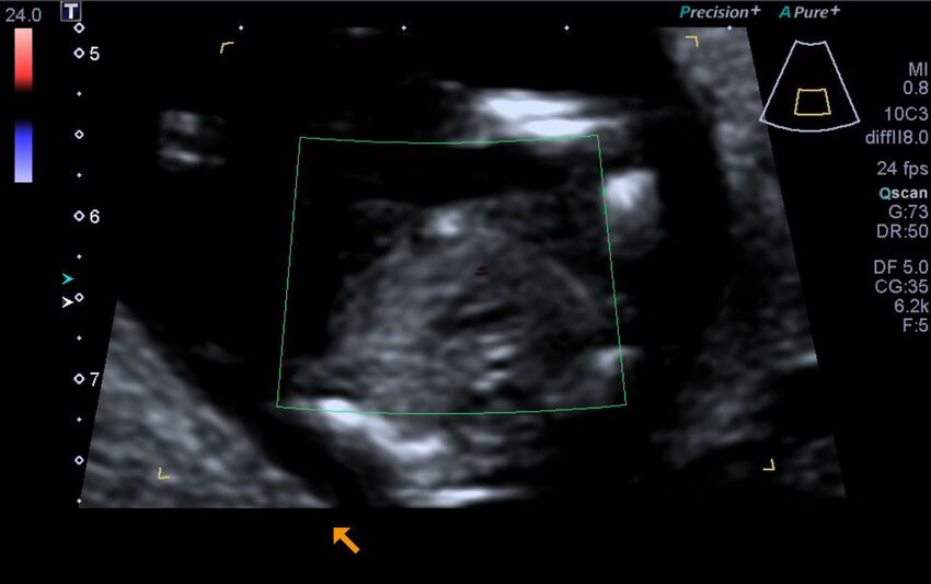 1st trimester nuchal-morphology ultrasound (Radiopaedia 44706-48477 Heart views cine with colour 143).jpg