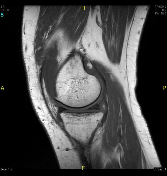 File:ACL mucoid degeration with cystic changes (Radiopaedia 48428-53341 Sagittal T1 6).jpg