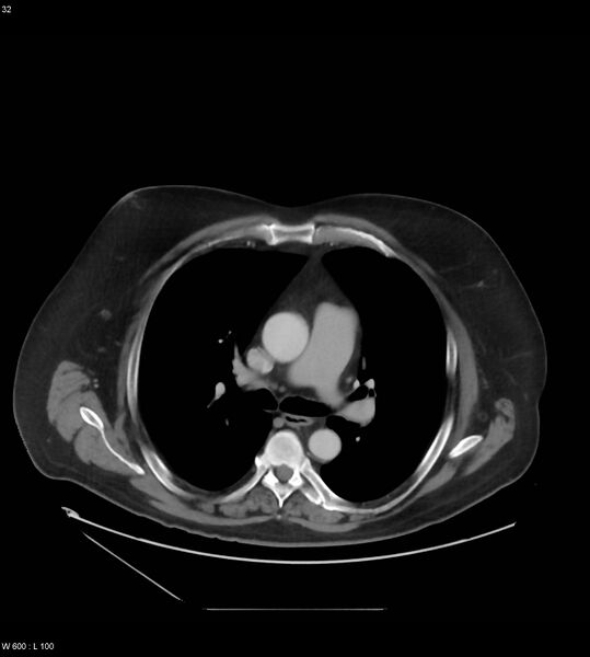 File:Abdominal aortic aneurysm with intramural hematoma then rupture (Radiopaedia 50278-55631 Axial C+ arterial phase 23).jpg