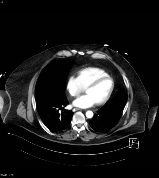 File:Abdominal aortic aneurysm with intramural hematoma then rupture (Radiopaedia 50278-55632 Axial C+ arterial phase 16).jpg