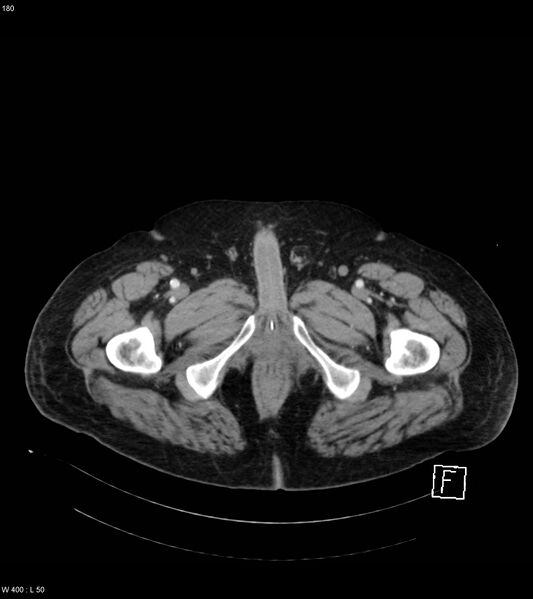 File:Abdominal aortic aneurysm with intramural hematoma then rupture (Radiopaedia 50278-55632 Axial C+ arterial phase 179).jpg