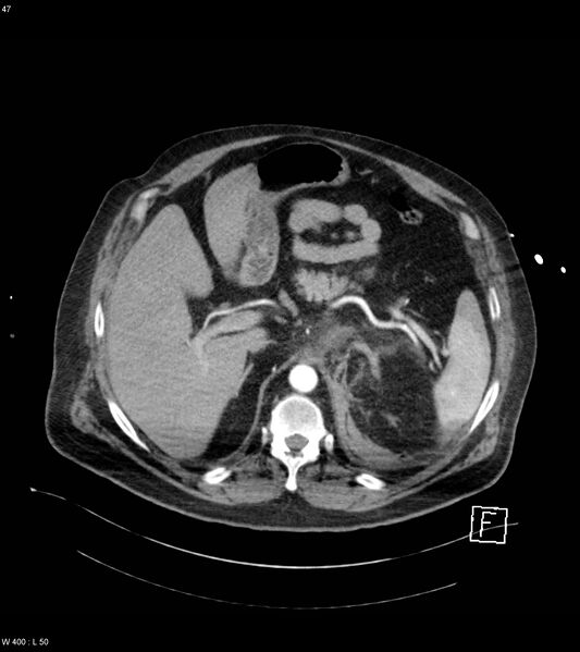 File:Abdominal aortic aneurysm with intramural hematoma then rupture (Radiopaedia 50278-55632 Axial C+ arterial phase 46).jpg