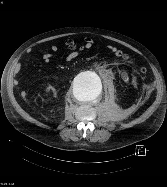File:Abdominal aortic aneurysm with intramural hematoma then rupture (Radiopaedia 50278-55632 Axial C+ arterial phase 92).jpg