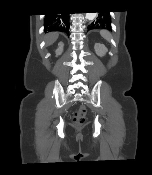 File:Abdominal aortic aneurysm with thrombus fissuration (Radiopaedia 46218-50618 Coronal C+ arterial phase 6).jpg