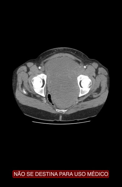 File:Abdominal desmoid tumor (Radiopaedia 44024-47540 Axial C+ arterial phase 49).jpg