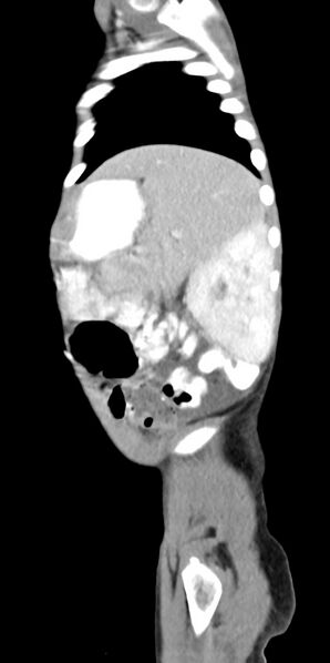 File:Abdominopelvic rhabdomyosarcoma (Radiopaedia 78356-90984 Sagittal C+ portal venous phase 18).jpg