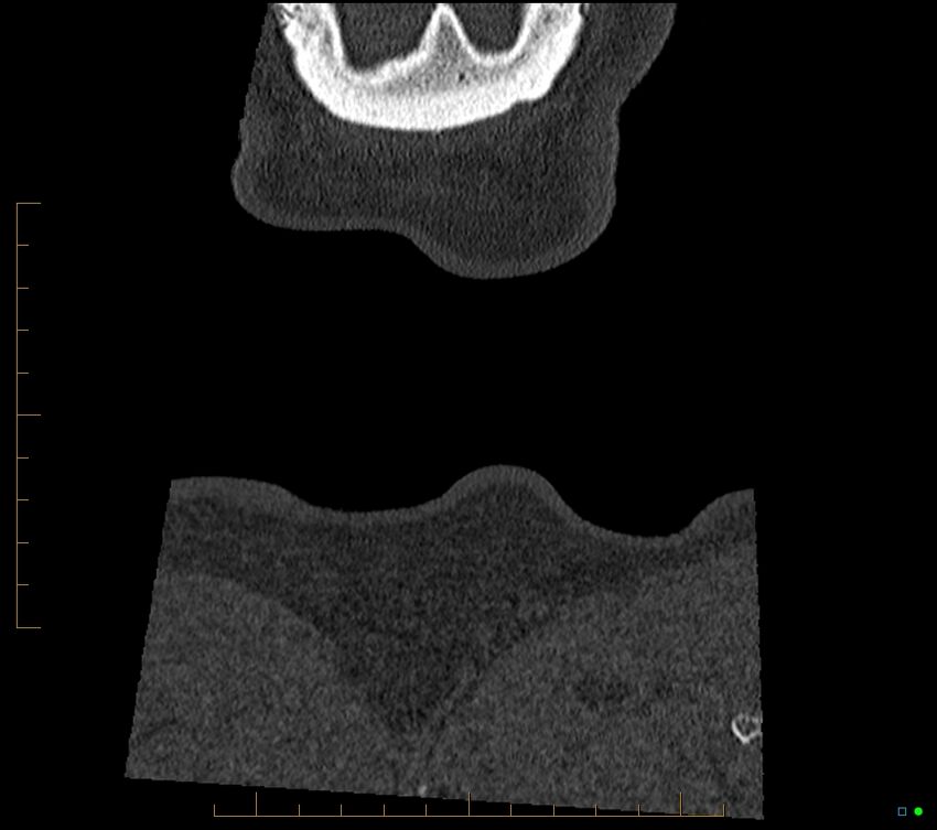 Accessory articulation of cervical transverse processes (Radiopaedia 82715-96933 Coronal non-contrast 139).jpg