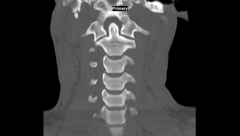 File:Accessory ossicle of the anterior arch of C1 vertebra (Radiopaedia 58149-65211 Coronal bone window 5).jpg