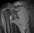 Acromioclavicular arthritis - rotator cuff tear (Radiopaedia 10890-11321 Coronal PD fat sat 1).jpg
