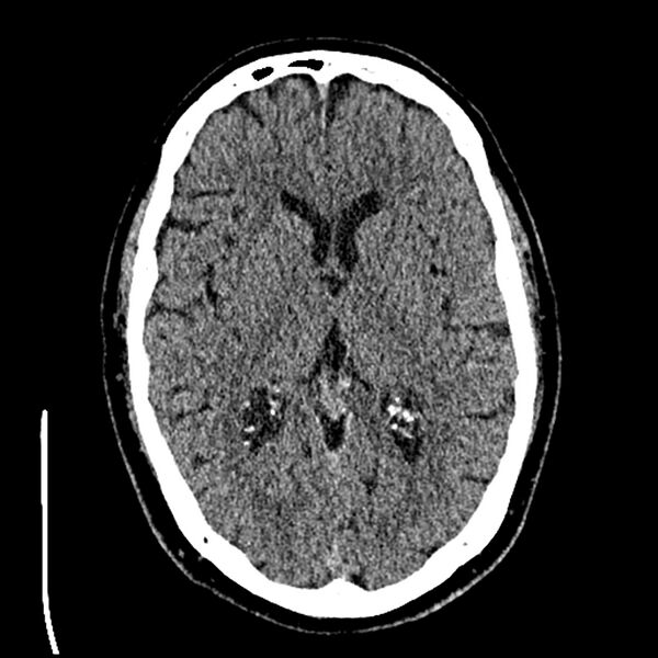 File:Acute A3 occlusion with ACA ischemic penumbra (CT perfusion) (Radiopaedia 72036-82525 Axial non-contrast thins 35).jpg