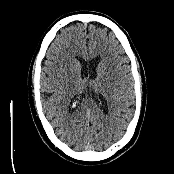 File:Acute A3 occlusion with ACA ischemic penumbra (CT perfusion) (Radiopaedia 72036-82525 Axial non-contrast thins 52).jpg