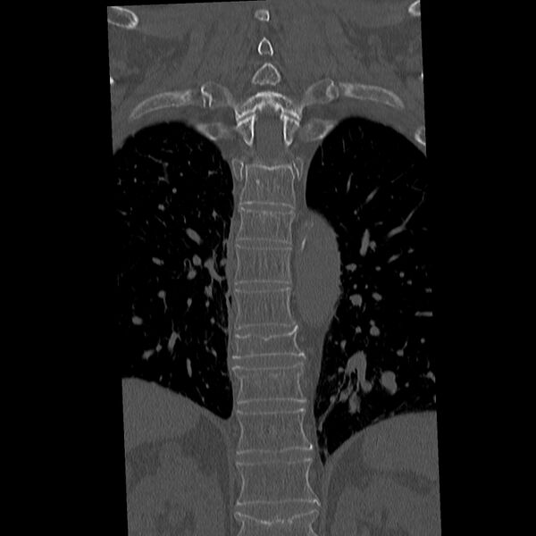 File:Acute and chronic vertebral compression fractures (Radiopaedia 31608-32494 Coronal bone window 24).jpg