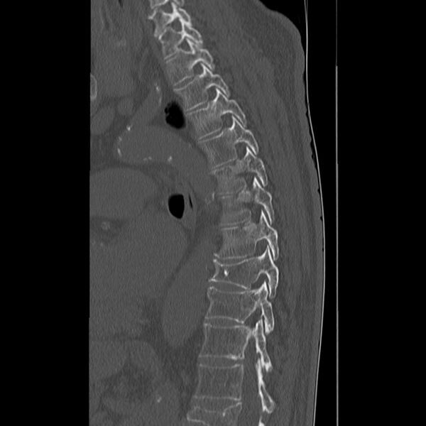 File:Acute and chronic vertebral compression fractures (Radiopaedia 31608-32494 Sagittal bone window 20).jpg