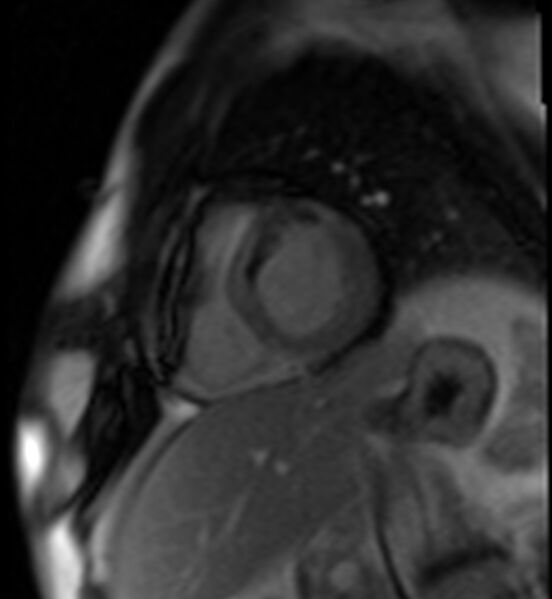 File:Acute anteroseptal myocardial infarction (Radiopaedia 68409-77945 Short axis (basal) Perfusion 36).jpg