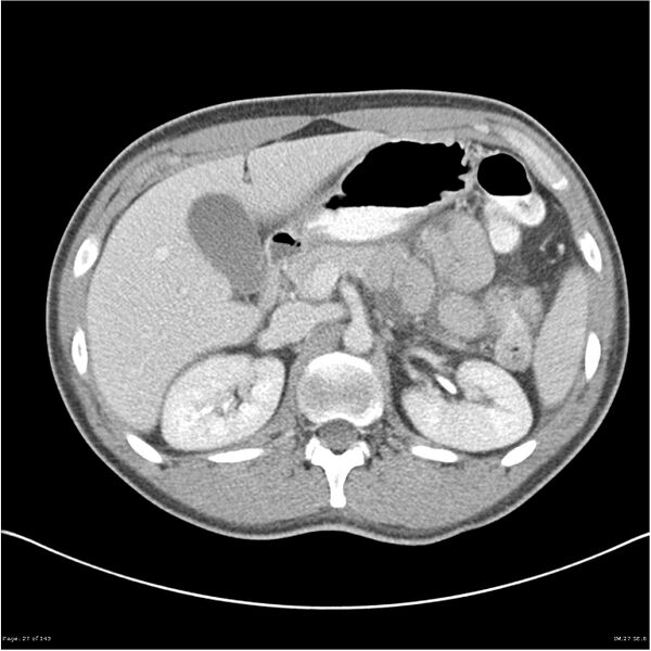 File:Acute appendicitis (Radiopaedia 25364-25615 B 17).jpg