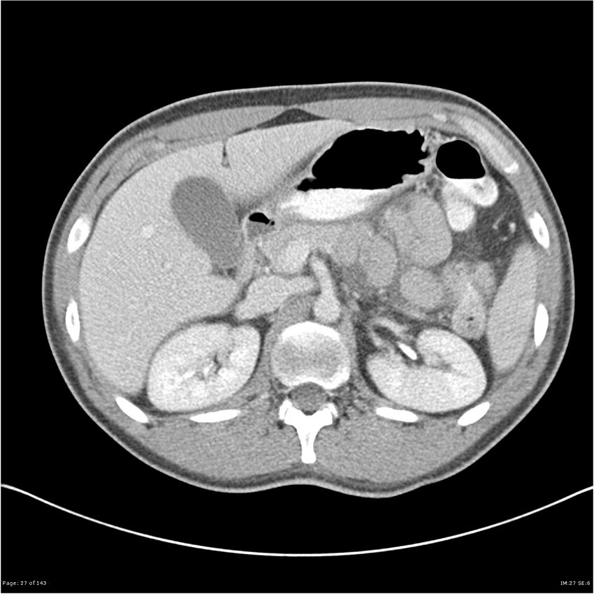 Acute appendicitis (Radiopaedia 25364-25615 B 17).jpg
